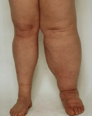 akathisia akathisia