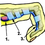 descrierea artrozei