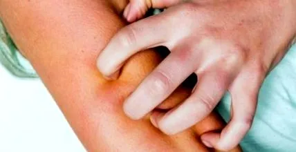 алергични реакции отслабване