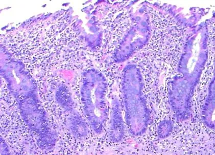 giardiasis giardiasis