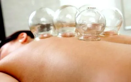 cupping медицински
