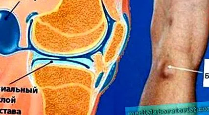 gonartroza clinice