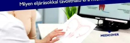 видалення міоми