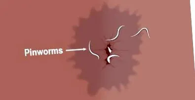 едномесечно бебе Pinworm бебе