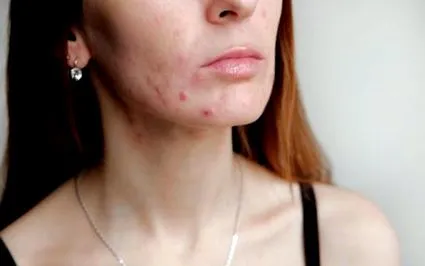 наистина акнето