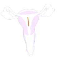 contraceptive free