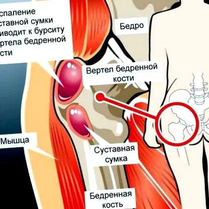 артрити teraflex