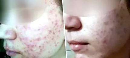 acne uriyea