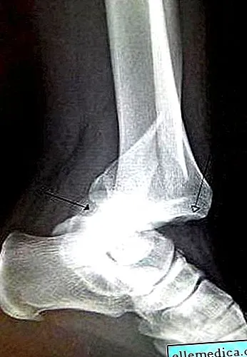 varicelor