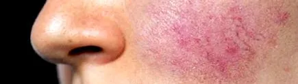 pylori helicobacter