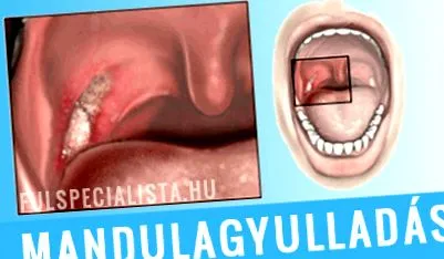 sytin migdalele