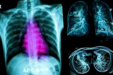 pulmonar simptomele