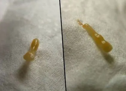 червеи малки чревни червеи