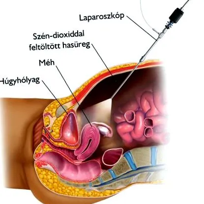 лапароскопия medicover