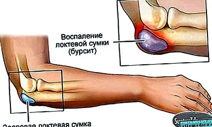 димексид артрит