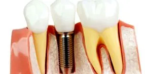 goldendental proteze