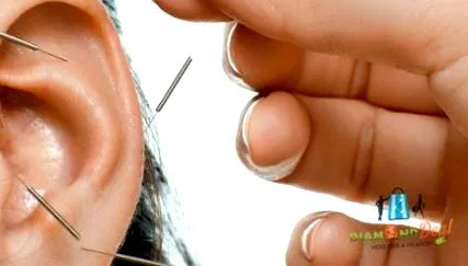 tratament acupunctura
