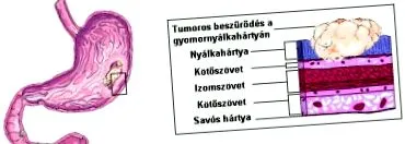 care este cancerului gastric