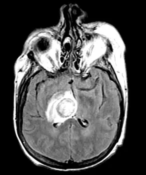 гельмінтозів вагітних гельмінтозів вагітних