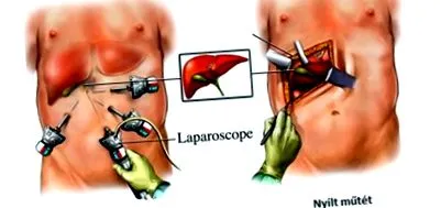 mamica laparoscopică