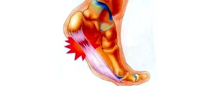 calcaneus spur