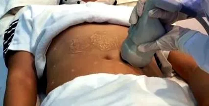 liposonix оборудване