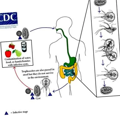 giardiasis giardia