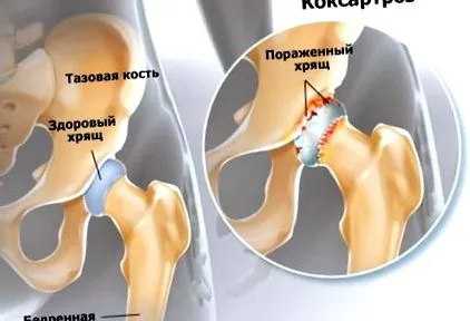 лечение гонартроза