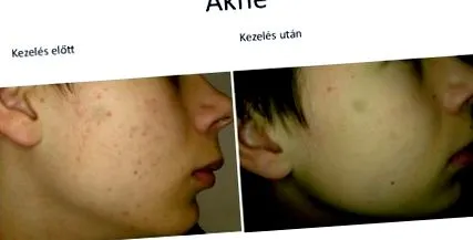 гарадерма акнето