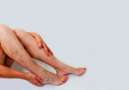 варикоз варикоз