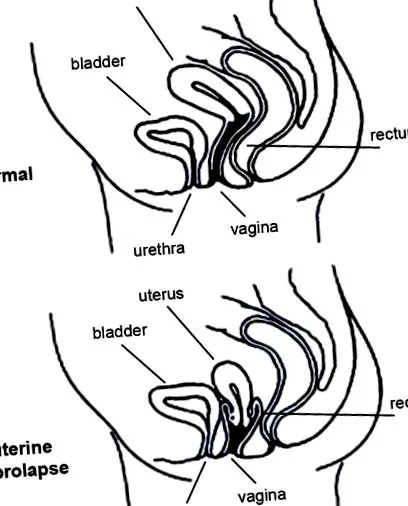 prolaps continence