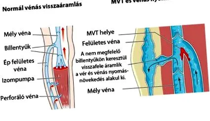 varicele spital