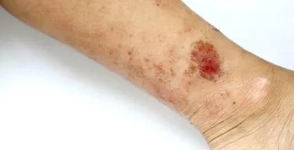 eczemă