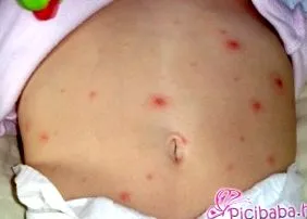 като този варицела