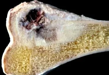 кунд perthes
