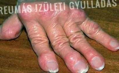 articulară articulară