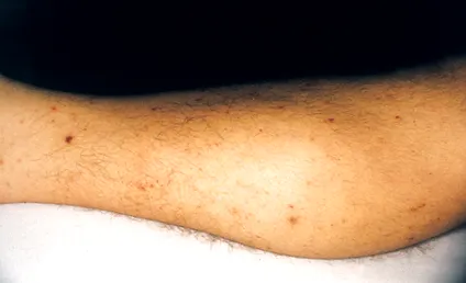 enterococcus запалення