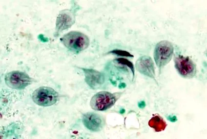 giardia педіатрія