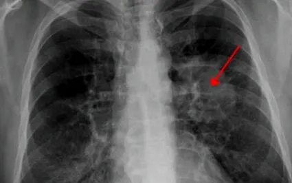 într-adevăr cancer