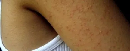 keratosis восъчна