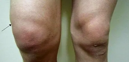 geluri osteocondroză
