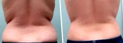 естетичен tightsculpting
