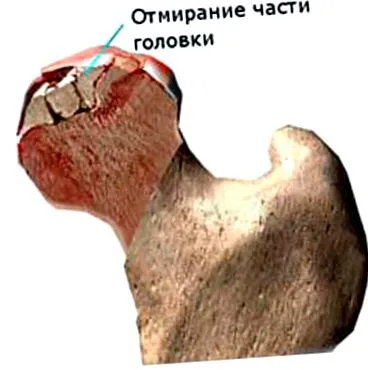 тазобедрената лекуваме