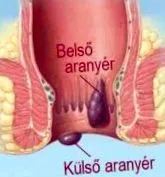 външно лечение