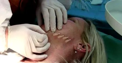 bio-meyisun absorbabile