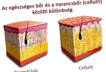 целулит Какво целулит