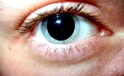 keratoconus какво