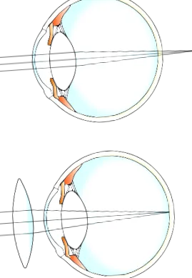 miopie hipermetropie vision