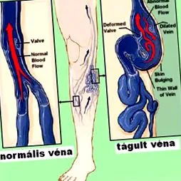 tromboze tromboze