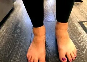 varicelor varicelor